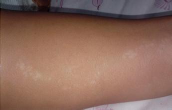 面部长白斑是怎么一回事啊 面部长白斑是怎么一回事啊.jpg